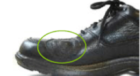 balloon patch orthopedic shoe